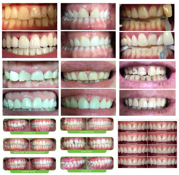 Before and After Dental Treatment