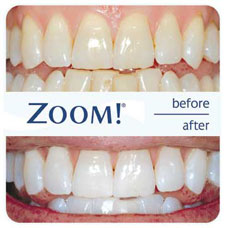zoom_whitening Zoom Whitening